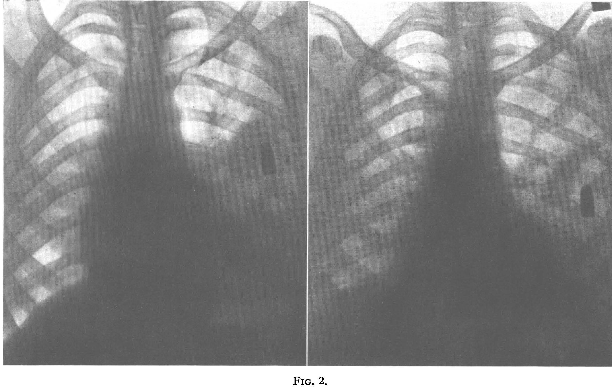 BulletWound18-176-180.jpg X-rays showing small entry bullet wound in second left intercostal