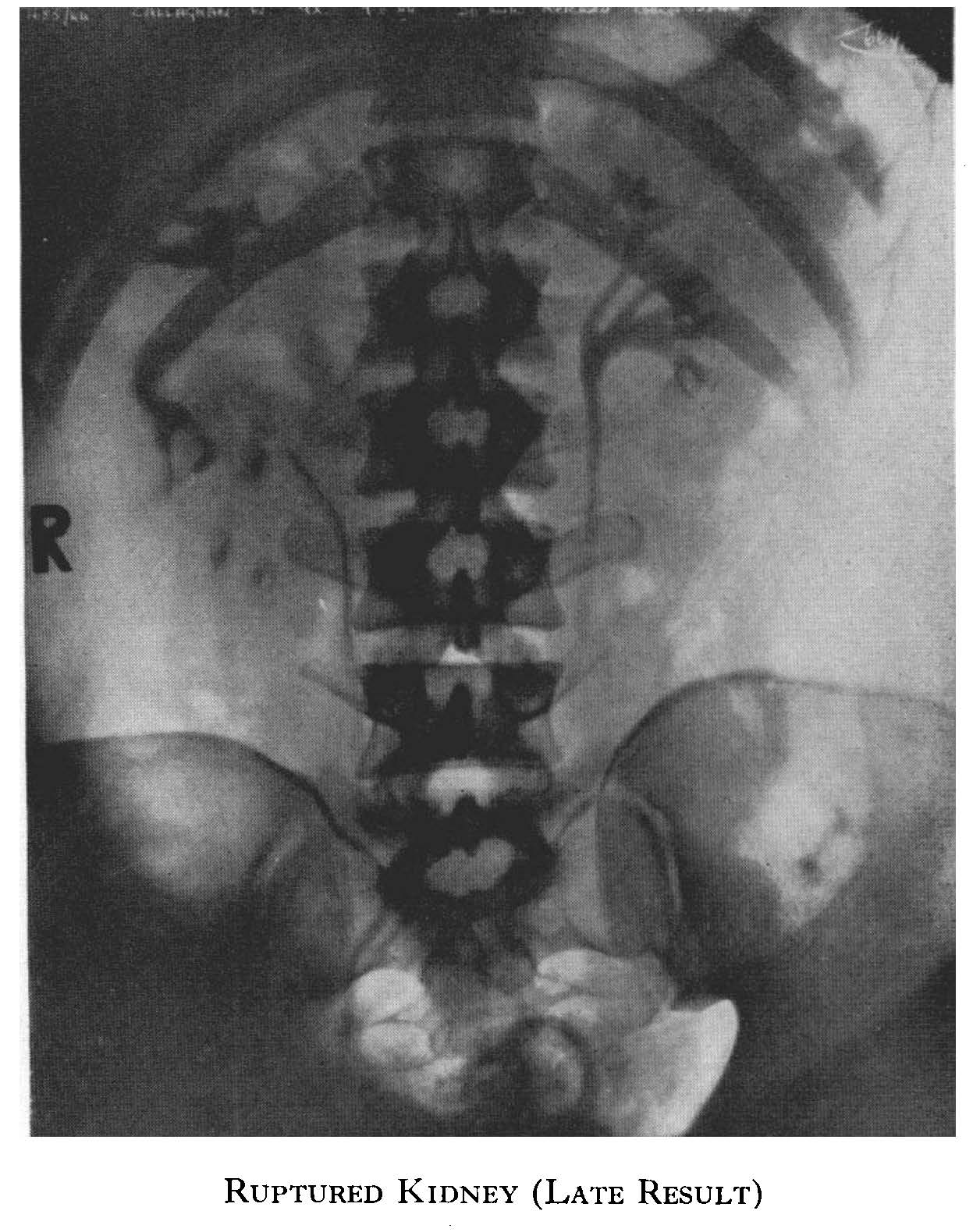 Urinary tract injury
