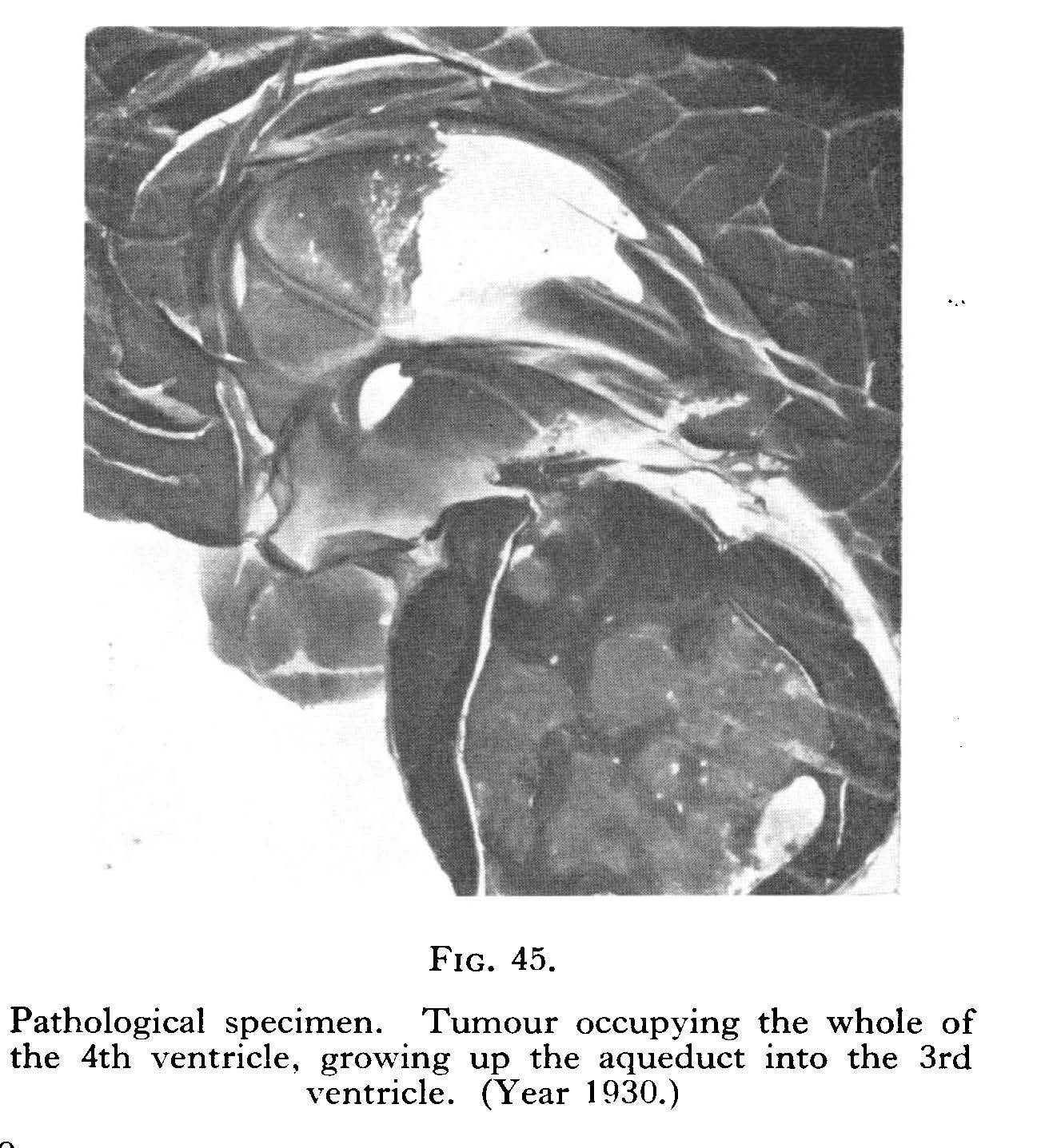 Tumour-19-437-52.jpg Tumour occupying the whole of the left ventricle