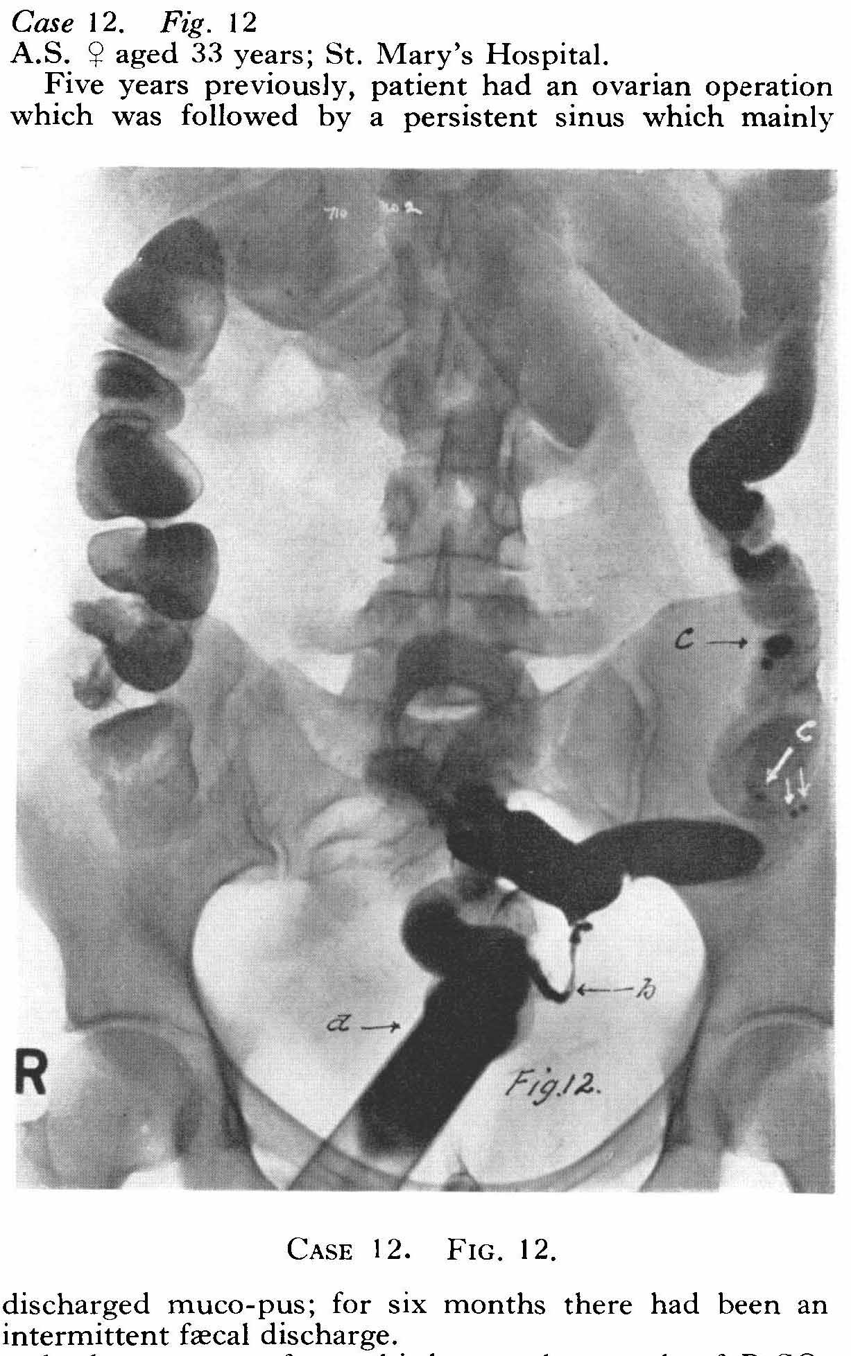 Contrastmedium-16-8-21.jpg Contrast medium in abdomen