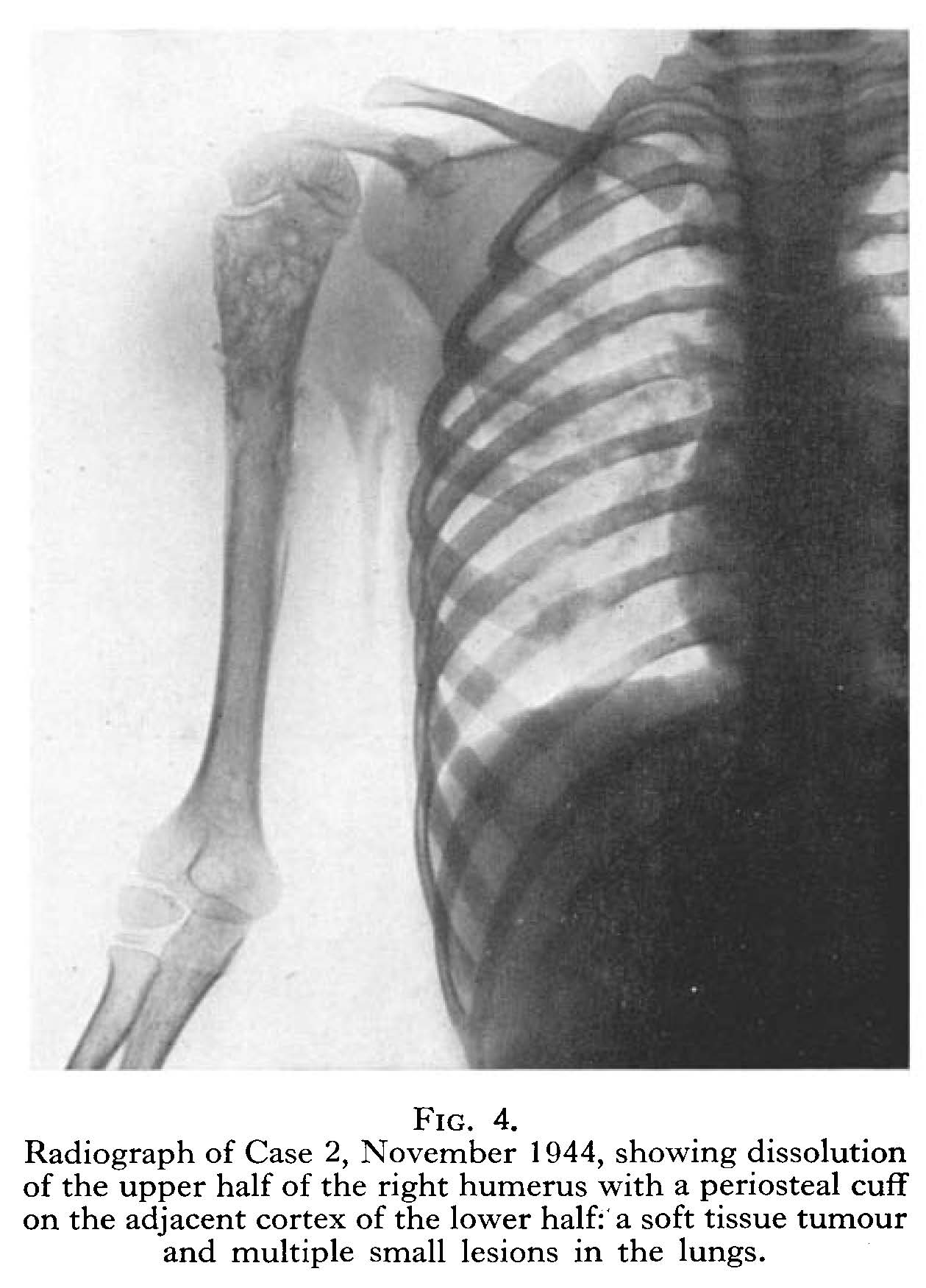 Tumour in the right humerus