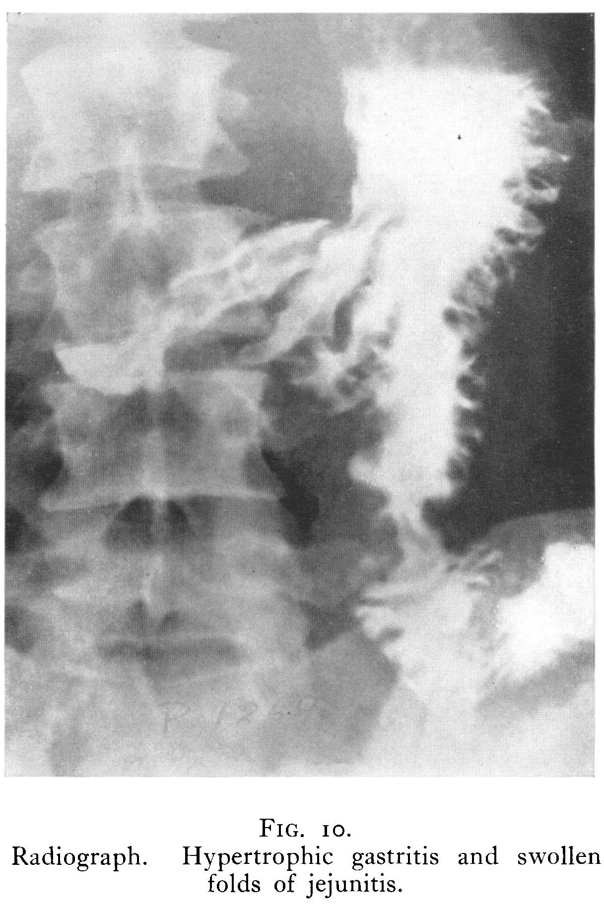 Radiograph showing gastritis and swollen folds of jejunum