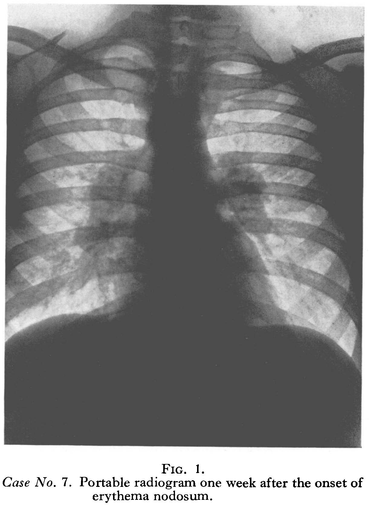 Radiogram of erythema nodosum