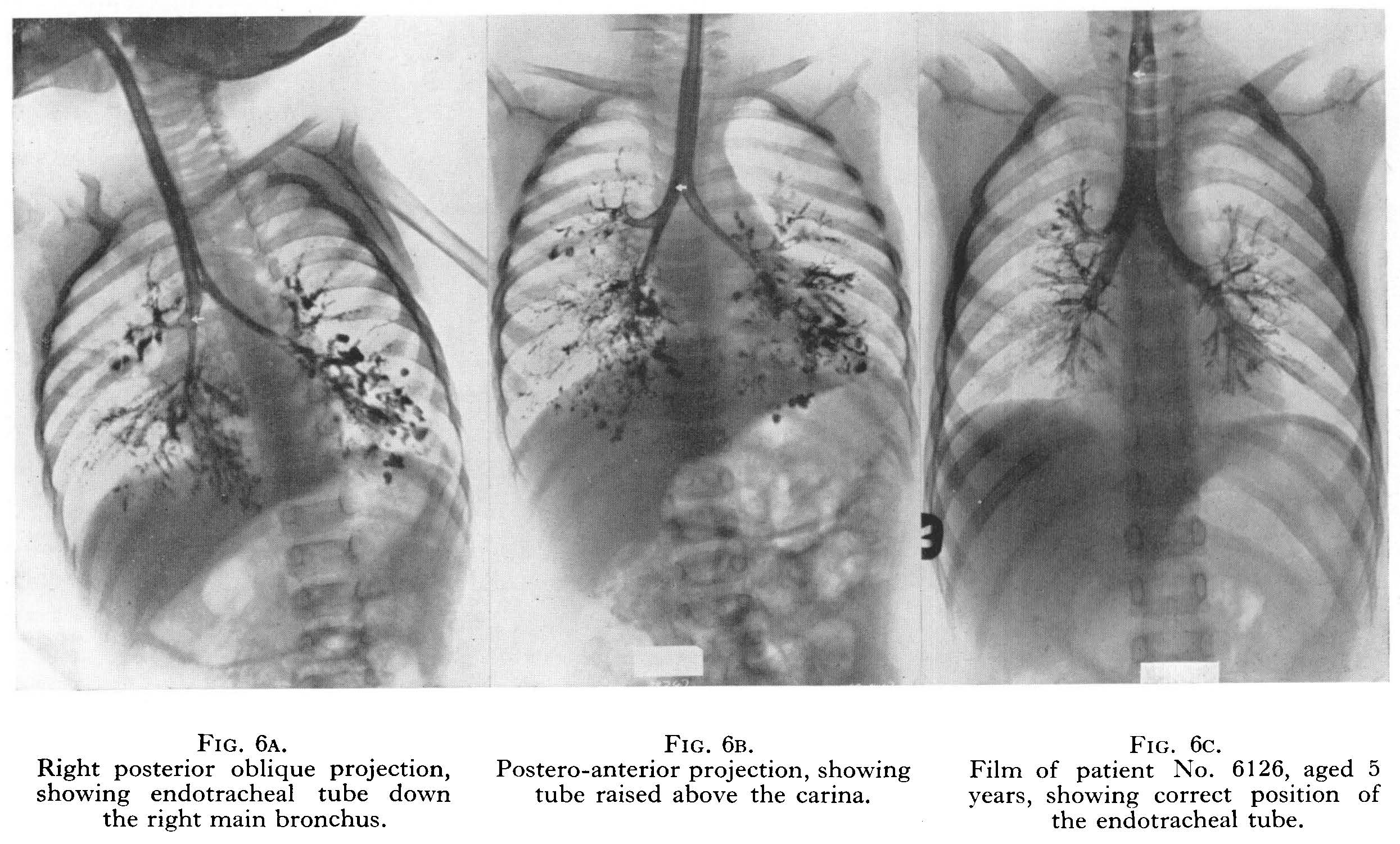 Bronchography22-137-151.jpg Bronchography - images of lungs