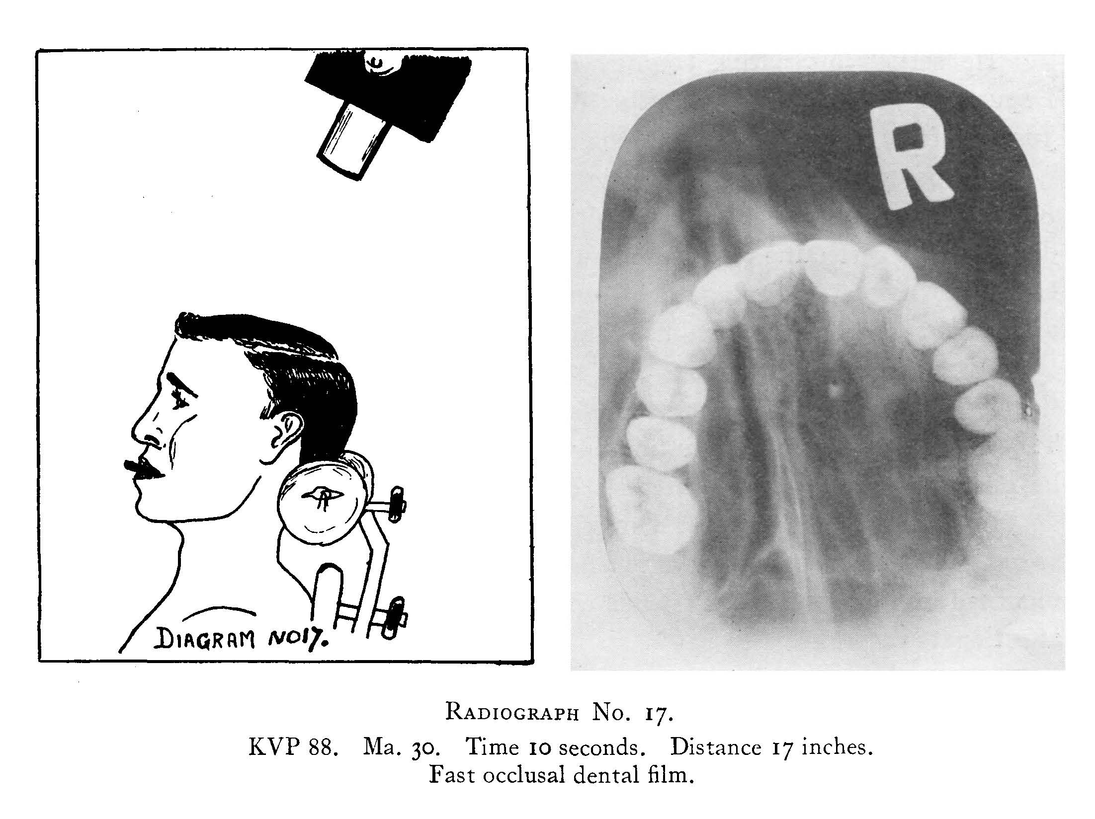 Fast occlusion dental film Fast occlusion dental film