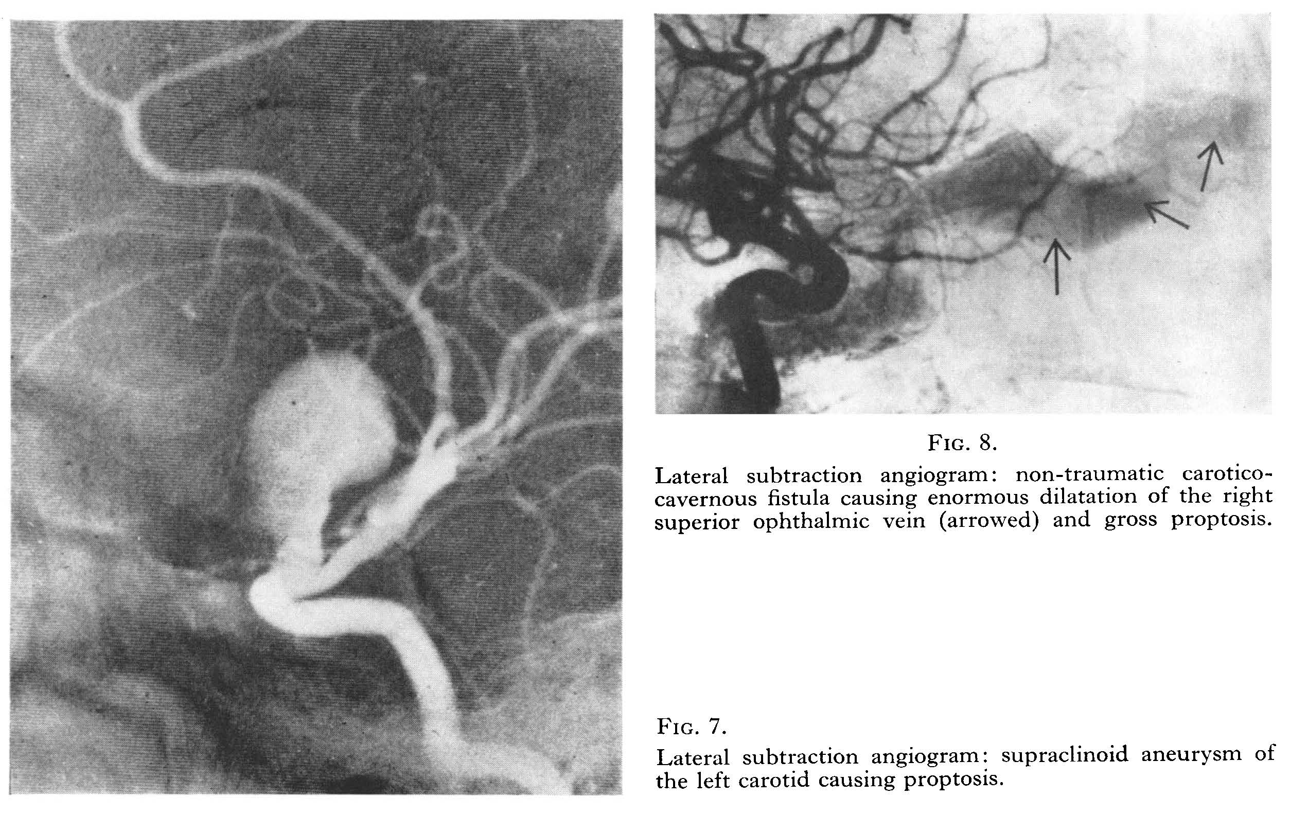 Images of lateral subtraction angiogram showing proptosis