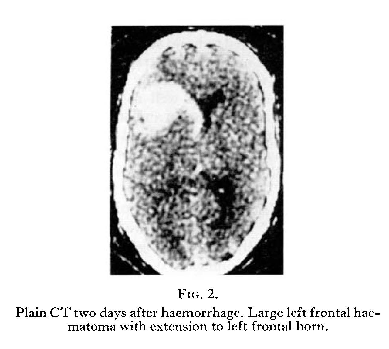 computed tomography of cerebral heamatoma computed tomography of cerebral heamatoma