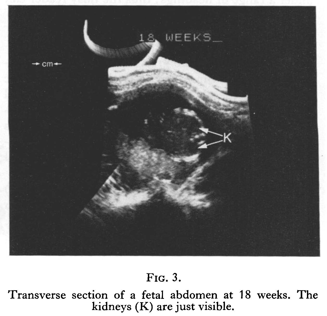Diagnostic imaging - fetal abdoment at 18 weeks