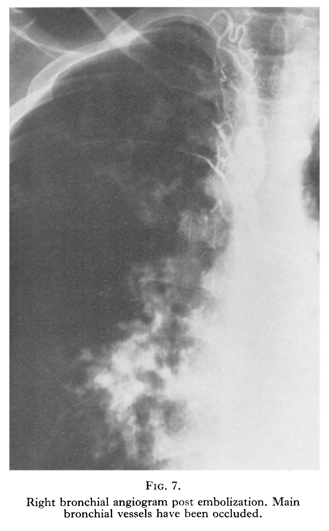 Bronchial embolisation