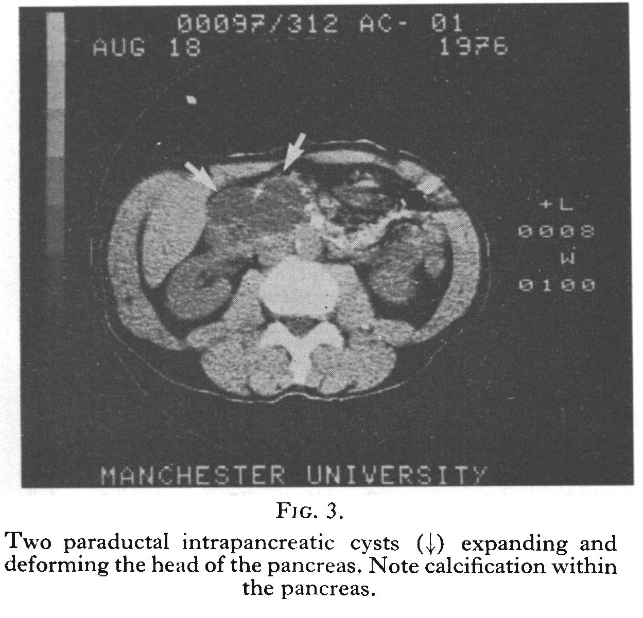 Computed tomography of pancreas with cysts Computed tomography of pancreas with cysts