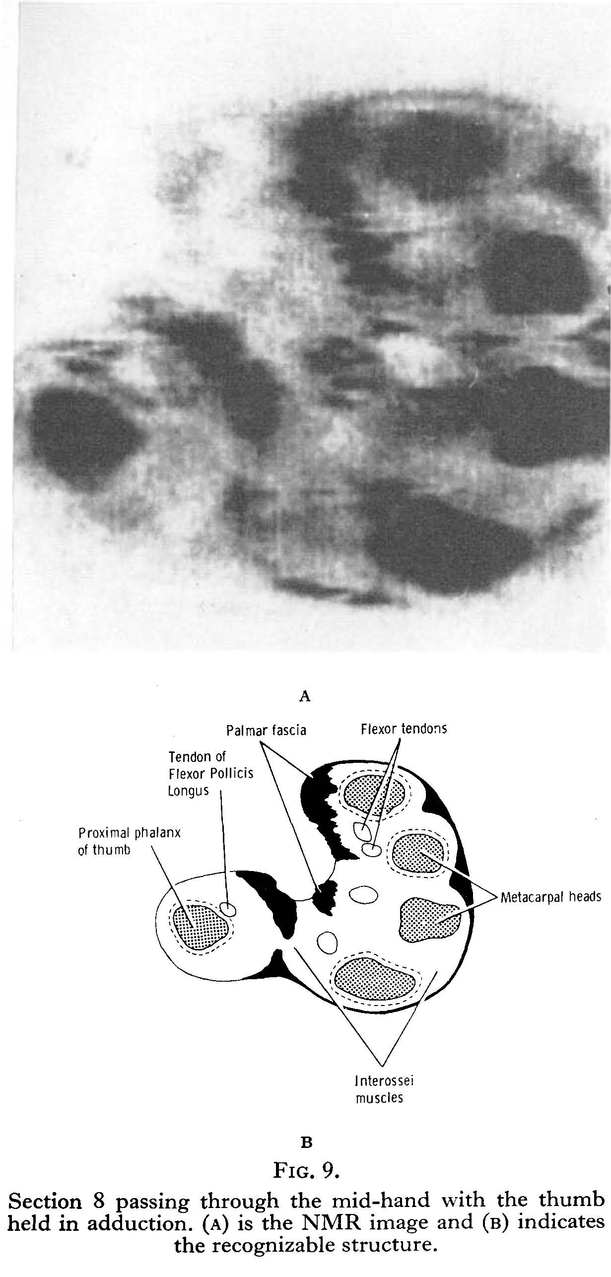 Fore-arm and hand NMR imaging