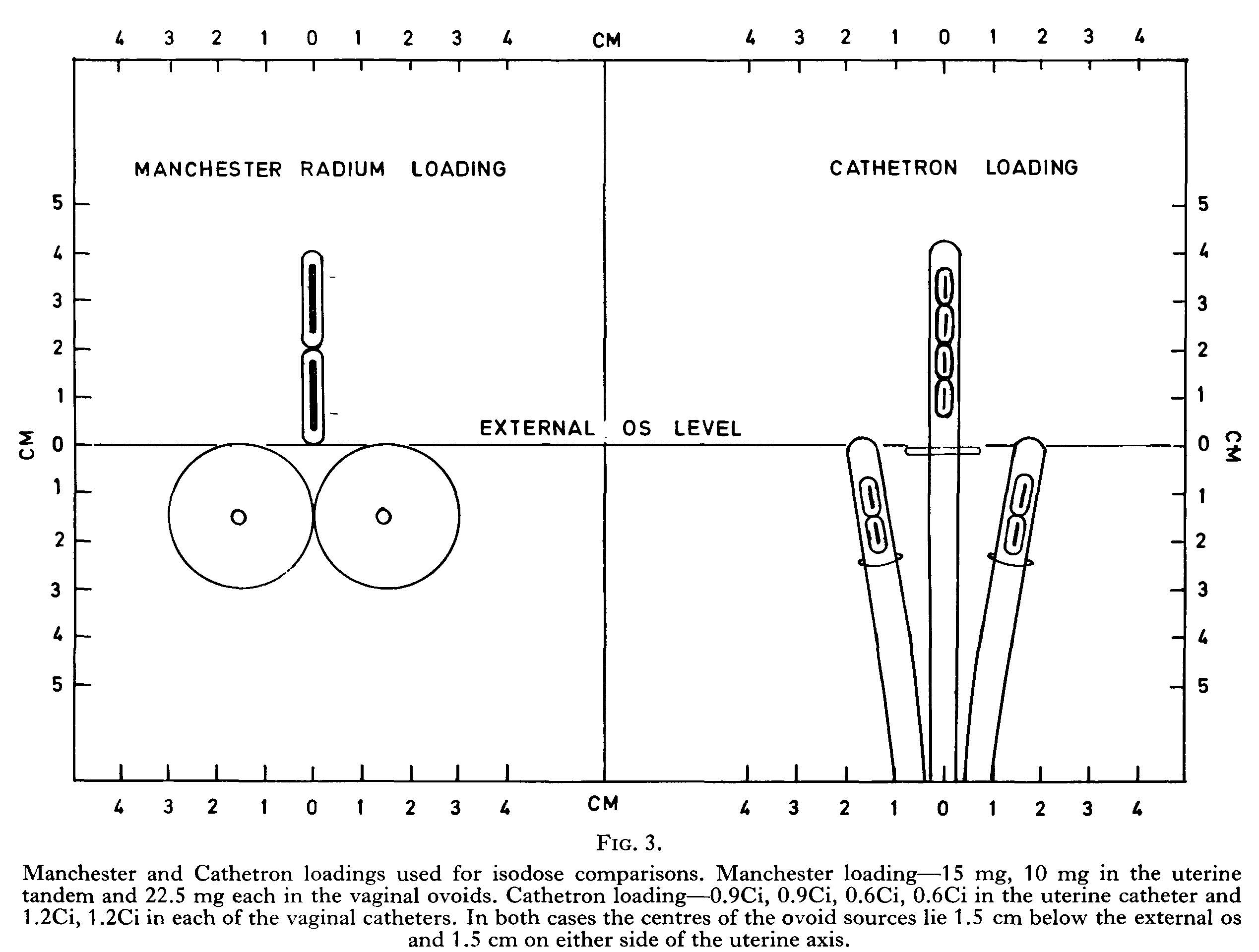 Manchester loading and cathetron loading used for isodose comparison Manchester loading and cathetron loading used for isodose comparison