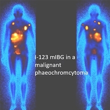 Radionuclide 131I-mIBG therapy: Science and Practice 
