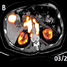 177Lu-PSMA therapy in Metastatic Prostate cancer: Science and Practice 