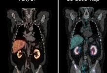 225Ac-PSMA therapy in Metastatic Prostate cancer