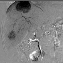 Selective internal radiation therapy (SIRT) -TheraSphere
