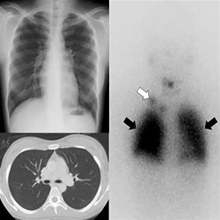 Radionuclide therapy-Origin, Evolution and Future 
