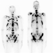 Radionuclide Bone Palliation Therapy 