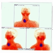 131I Radioiodine therapy in benign thyroid disease: Science and Practice  